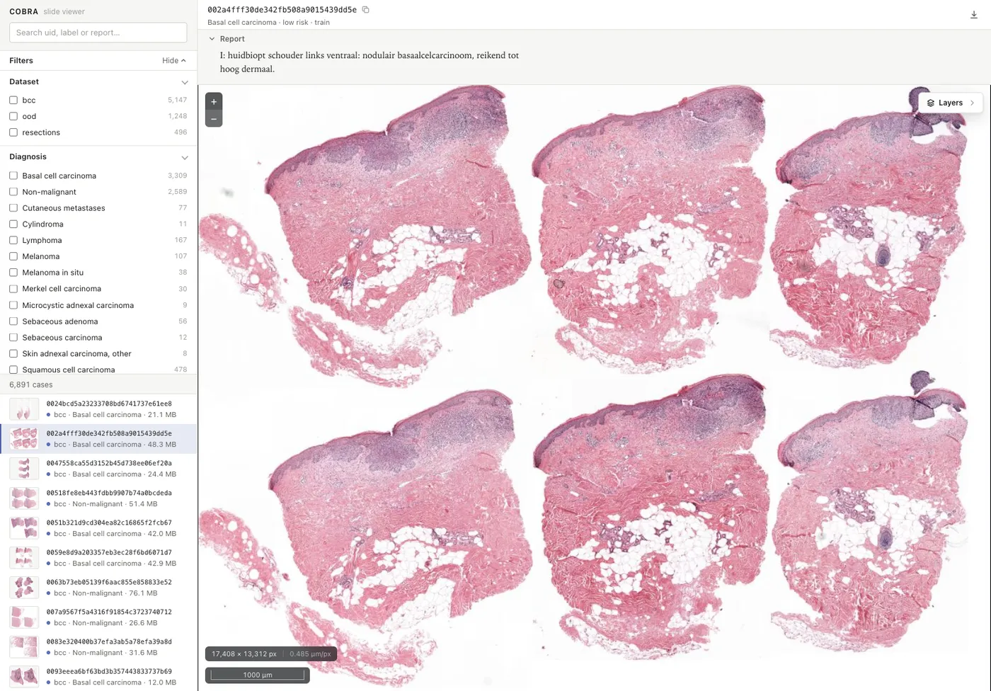 The COBRA slide viewer with a basal cell carcinoma case open: case list and filters on the left, the pathology report above the slide, and six serial tissue sections in the viewer.